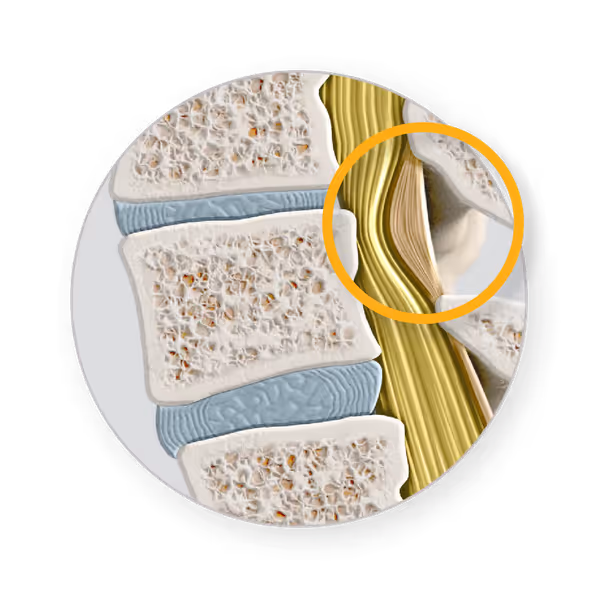Minimally Invasive Lumbar Decompression (MILD): A Breakthrough for Spinal Canal Stenosis Relief